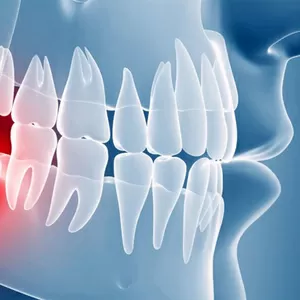 Качественное удаление зуба мудрости в Черкассах